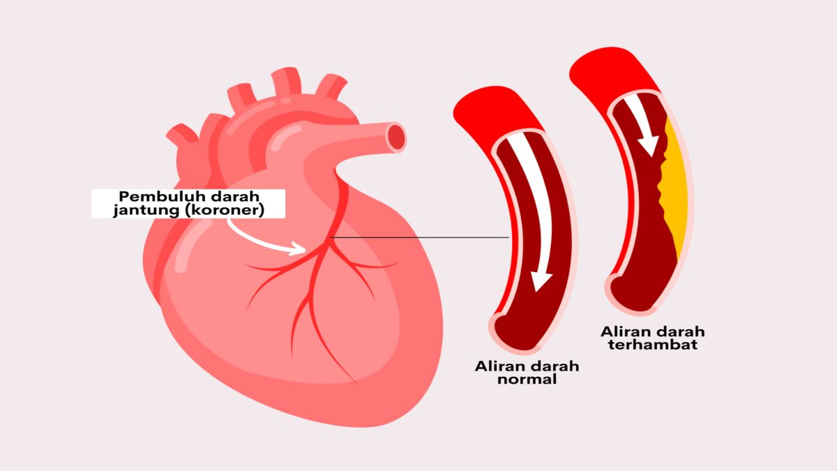 Faktor Utama Penyakit Jantung Koroner dan Cara Menguranginya