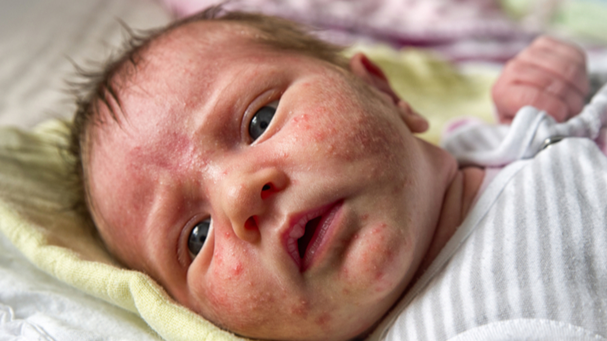 Masalah Kulit pada Bayi: Penyebab,Pengobatan, dan Pencegahan